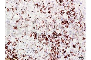 Formalin-fixed and paraffin embedded mouse melanoma labeled with Anti-Melanoma HMB45/Melanoma/Melan-A/MART-1 Polyclonal Antibody, Unconjugated (ABIN724190) at 1:200 followed by conjugation to the secondary antibody and DAB staining. (MLANA Antikörper  (AA 51-118))