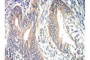 Immunohistochemical analysis of paraffin-embedded rectum cancer tissues using TIA1 mouse mAb with DAB staining. (TIA1 Antikörper  (AA 1-215))