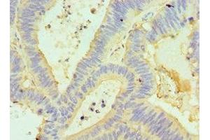 Immunohistochemistry of paraffin-embedded human colon cancer using ABIN7154304 at dilution of 1:100 (GORASP1 Antikörper  (AA 221-440))