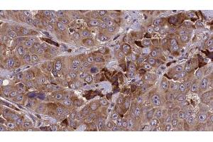 ABIN6273843 at 1/100 staining Human liver cancer tissue by IHC-P. (DRD5 Antikörper  (N-Term))