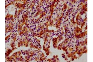 IHC image of ABIN7127701 diluted at 1:100 and staining in paraffin-embedded human lung cancer performed on a Leica BondTM system. (Rekombinanter HSP27 Antikörper  (pSer82))