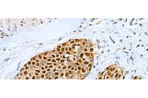 Immunohistochemistry of paraffin-embedded Human esophagus cancer tissue using TFAP4 Polyclonal Antibody at dilution of 1:70(x200) (TFAP4 Antikörper)
