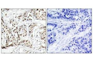 Immunohistochemical analysis of paraffin-embedded human breast carcinoma tissue using SAPK/JNK(Phospho-Thr183) Antibody(left) or the same antibody preincubated with blocking peptide(right). (MAPK9/MAPK1 (pThr183) Antikörper)