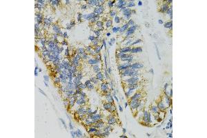 Immunohistochemistry of paraffin-embedded human gastric cancer using SLC27A2 antibody (ABIN5970435) at dilution of 1/100 (40x lens).
