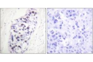 Immunohistochemistry analysis of paraffin-embedded human lung carcinoma tissue, using HDAC1 Antibody. (HDAC1 Antikörper  (AA 433-482))