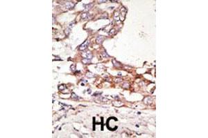 Formalin-fixed and paraffin-embedded human hepatocellular carcinoma tissue reacted with the SUMO4 polyclonal antibody  , which was peroxidase-conjugated to the secondary antibody, followed by AEC staining. (SUMO4 Antikörper  (Internal Region))