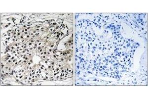 Immunohistochemistry analysis of paraffin-embedded human breast carcinoma tissue, using PECI Antibody. (PECI/ECI2 Antikörper  (AA 73-122))