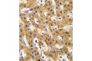 Formalin-fixed and paraffin-embedded human hepatocarcinoma tissue reacted with Phospho-PDX1-T11. (PDX1 Antikörper  (AA 1-30))