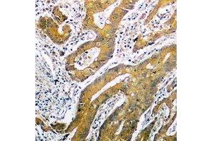 Immunohistochemical analysis of p53 staining in human colon cancer formalin fixed paraffin embedded tissue section. (p53 Antikörper  (C-Term))