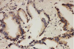 Anti- CUL1antibody, IHC(P) IHC(P): Human Lung Cancer Tissue (Cullin 1 Antikörper  (N-Term))