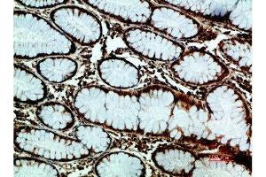 Immunohistochemical analysis of paraffin-embedded human-colon-cancer, antibody was diluted at 1:200 (GRP78 Antikörper  (AA 1268-1341))