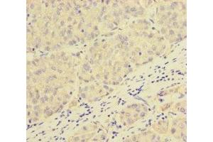 Immunohistochemistry of paraffin-embedded human liver cancer using ABIN7162979 at dilution of 1:100 (PEX16 Antikörper  (AA 132-336))