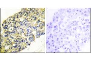 Immunohistochemistry analysis of paraffin-embedded human breast carcinoma tissue, using PI3-kinase p85-alpha/gamma (Ab-467/199) Antibody. (PI3K p85 alpha/gamma Antikörper  (AA 436-485))