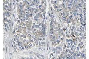 ABIN6278486 at 1/100 staining human lung carcinoma tissue sections by IHC-P.