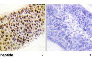 Immunohistochemical analysis of paraffin-embedded human liver carcinoma tissue using KAT5 polyclonal antibody .