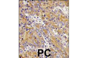 Formalin-fixed and paraffin-embedded human prostata carcinoma tissue reacted with MYO1C antibody , which was peroxidase-conjugated to the secondary antibody, followed by DAB staining.
