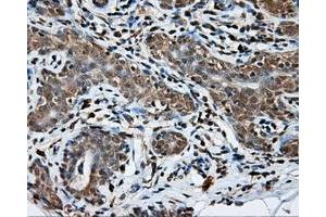 Immunohistochemical staining of paraffin-embedded breast tissue using anti-NPR3 mouse monoclonal antibody. (NPR3 Antikörper)