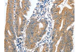 The image on the left is immunohistochemistry of paraffin-embedded Human colon cancer tissue using ABIN7128903(CENPC Antibody) at dilution 1/70, on the right is treated with fusion protein. (Centromere Protein C Pseudogene 1 (CENPCP1) Antikörper)