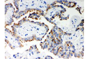 Anti- ITPR3 Picoband antibody, IHC(P) IHC(P): Human Lung Cancer Tissue (ITPR3 Antikörper  (N-Term))