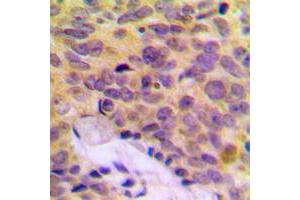 Immunohistochemical analysis of MRPL16 staining in human breast cancer formalin fixed paraffin embedded tissue section. (MRPL16 Antikörper  (C-Term))