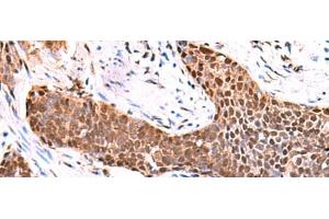 Immunohistochemistry of paraffin-embedded Human esophagus cancer tissue using TSEN2 Polyclonal Antibody at dilution of 1:80(x200) (TSEN2 Antikörper)