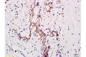 Formalin-fixed and paraffin embedded human breast carcinoma labeled with Anti CD11a Polyclonal Antibody, Unconjugated (ABIN734678) at 1:200 followed by conjugation to the secondary antibody and DAB staining