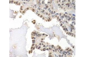 Immunohistochemistry of paraffin-embedded Human thyroid cancer using GTF2F1 Polyclonal Antibody at dilution of 1:200 (40x lens).