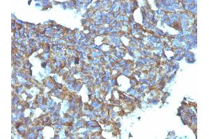 Formalin-fixed, paraffin-embedded human Ovarian Carcinoma stained with CD99 Monoclonal Antibody (MIC2/877).