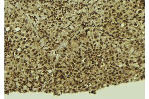 ABIN6272432 at 1/100 staining Human breast cancer tissue by IHC-P. (Sp3/4 Antikörper)