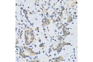 Immunohistochemistry of paraffin-embedded human gastric cancer using SLC2A13 antibody. (SLC2A13 Antikörper  (AA 564-648))