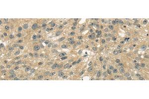 Immunohistochemistry of paraffin-embedded Human breast cancer tissue using UGT2B4 Polyclonal Antibody at dilution 1:45
