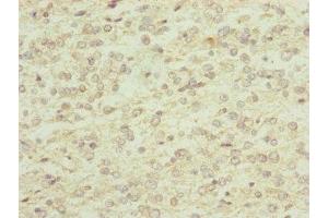 Immunohistochemistry of paraffin-embedded human glioma using ABIN7151143 at dilution of 1:100 (RNF13 Antikörper  (AA 204-381))