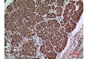 Immunohistochemistry (IHC) analysis of paraffin-embedded Human Pancreas Cancer, antibody was diluted at 1:100. (SERPINA3 Antikörper  (Internal Region))