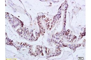 Formalin-fixed and paraffin embedded human colon carcinoma labeled with Anti-Ack1 Polyclonal Antibody, Unconjugated (ABIN673659) at 1:200 followed by conjugation to the secondary antibody and DAB staining. (TNK2 Antikörper  (AA 301-420))
