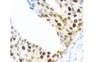 Immunohistochemistry of paraffin-embedded Human prostate cancer using KHDRBS2 Polyclonal Antibody at dilution of 1:100 (40x lens). (KHDRBS2 Antikörper)
