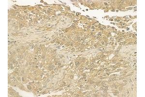 ABIN6262856 and ABIN6277036 at 1/100 staining human lung squamous cell carcinoma by IHC-P.