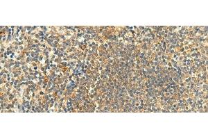 Immunohistochemistry of paraffin-embedded Human tonsil tissue using CLEC4D Polyclonal Antibody at dilution of 1:50(x200) (CLEC4D Antikörper)