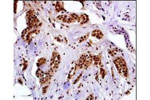 Immunostaining of paraformldehyde-fixed and paraffin-embedded hun breast carcino with GE-A4 antibody Cat (ABIN390108 and ABIN2840620) (1:50 dilution), followed by reacting with biotin-conjugated secondary antibody, ABC solution and developing with DAB. (MAGEA4 Antikörper  (N-Term))