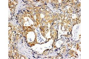 IHC-P: SDHC antibody testing of human gastric cancer tissue (SDHC Antikörper  (N-Term))