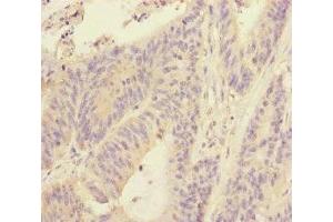 Immunohistochemistry of paraffin-embedded human colon cancer using ABIN7170628 at dilution of 1:100 (RBM17 Antikörper  (AA 1-240))