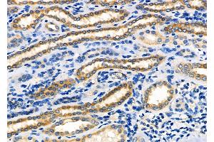 ABIN6259064 and ABIN6273426 at 1/100 staining Human kidney cancer and adjacent normal tissues by IHC-P.
