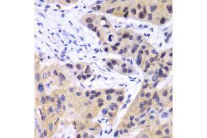 Immunohistochemistry of paraffin-embedded human esophageal cancer using IRF3 antibody (ABIN4904079) at dilution of 1:100 (40x lens). (IRF3 Antikörper)