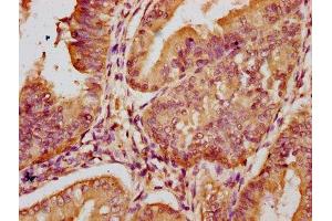 IHC image of ABIN7151049 diluted at 1:100 and staining in paraffin-embedded human endometrial cancer performed on a Leica BondTM system.