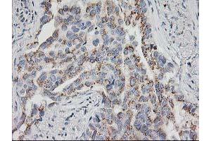 Immunohistochemical staining of paraffin-embedded Carcinoma of Human lung tissue using anti-HOXC11 mouse monoclonal antibody. (HOXC11 Antikörper)