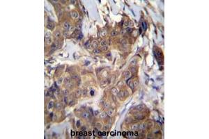 ATP6V1B1 Antibody (C-term) immunohistochemistry analysis in formalin fixed and paraffin embedded human breast carcinoma followed by peroxidase conjugation of the secondary antibody and DAB staining.