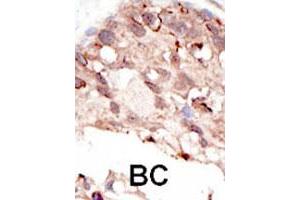Formalin-fixed and paraffin-embedded human cancer tissue reacted with the SUV39H2 polyclonal antibody  , which was peroxidase-conjugated to the secondary antibody, followed by DAB staining. (SUV39H2 Antikörper  (AA 308-337))