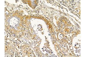 ABIN7093122 and ABIN7098213 at 1/100 staining human gastric cancer by IHC-P. (DLEU1 Antikörper  (C-Term))