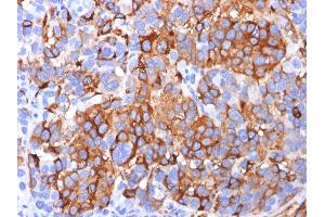 Formalin-fixed, paraffin-embedded human Melanoma stained with MART-1 / Melan-A Mouse Monoclonal Antibody (A103). (MLANA Antikörper)