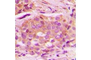 Immunohistochemical analysis of CNPY3 staining in human breast cancer formalin fixed paraffin embedded tissue section.