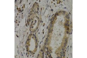 Immunohistochemistry of paraffin-embedded human stomach cancer using MAGEA1 antibody (ABIN5973183) at dilution of 1/200 (40x lens). (MAGEA1 Antikörper)